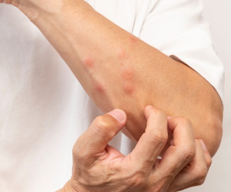 Insectensteken en -beten: zo voorkom, herken en behandel je ze tijdens je vakantie