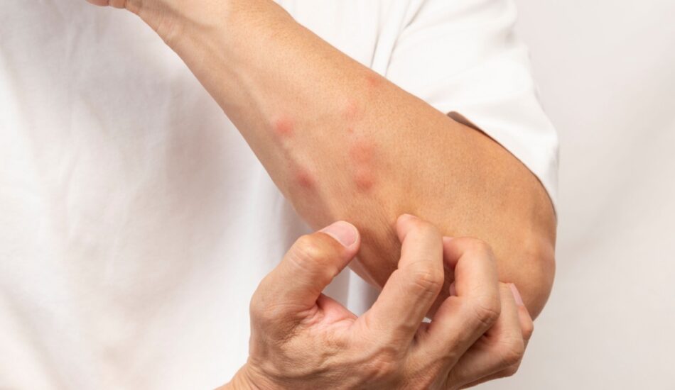 Insectensteken en -beten: zo voorkom, herken en behandel je ze tijdens je vakantie