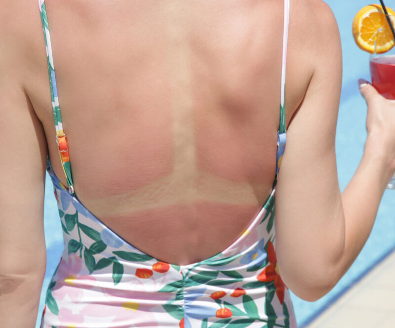Veelgemaakte fouten bij het smeren van zonnebrand: zo doe je het wel goed